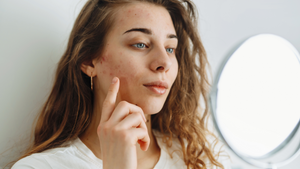 What Is Acne and How Can We Prevent It?