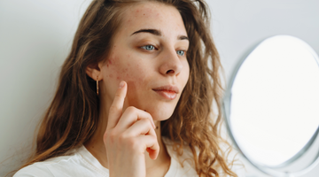 What Is Acne and How Can We Prevent It?